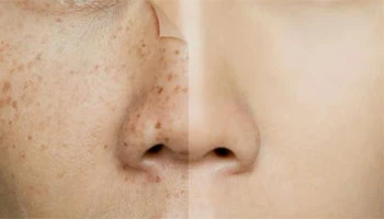 Ghid de îndepărtare a pigmentului Pico Laser